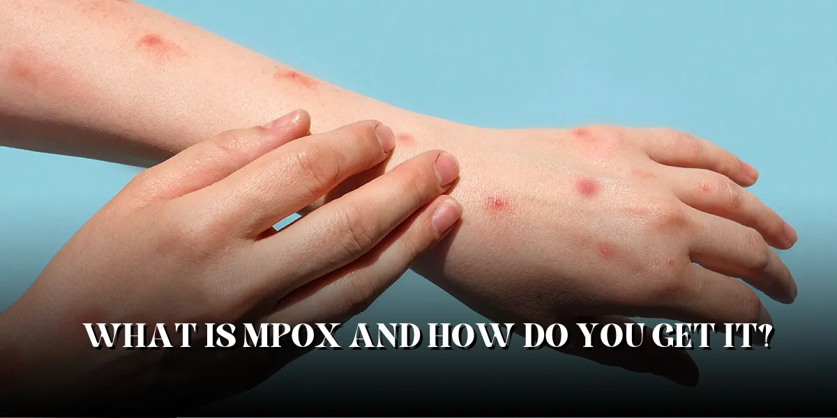 What is Mpox and How Do You Get It?