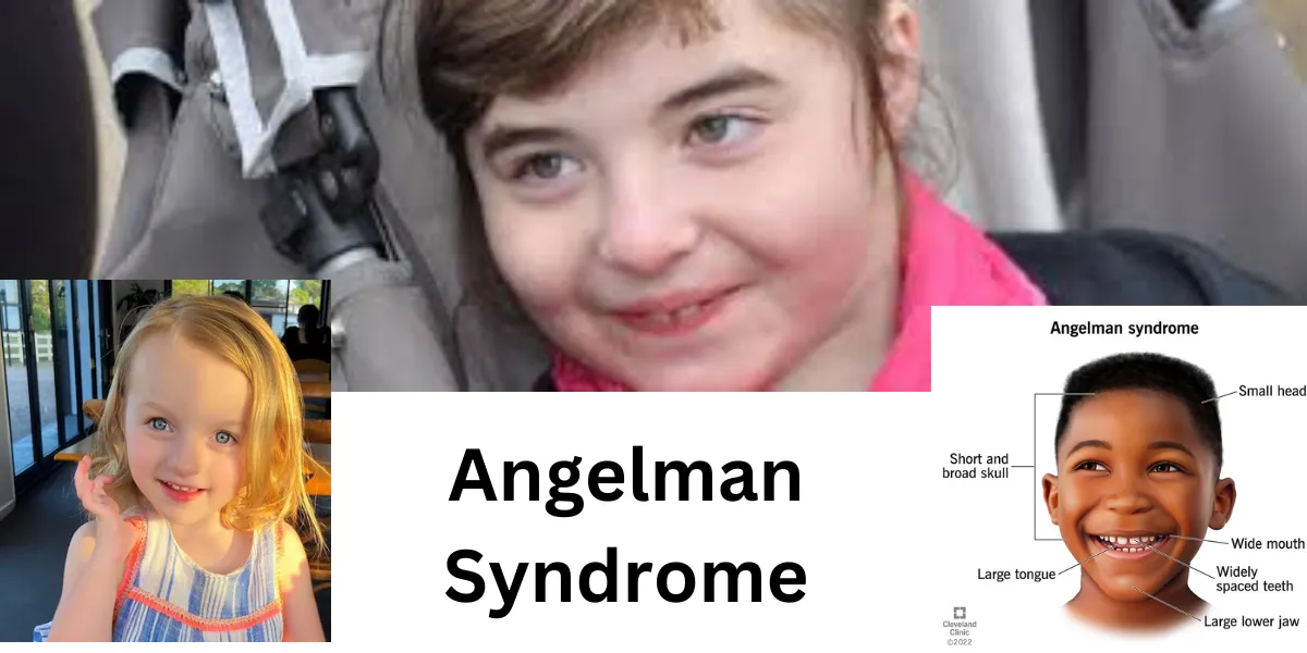 Angelman Syndrome: A Spotlight on a Rare Condition in the USA